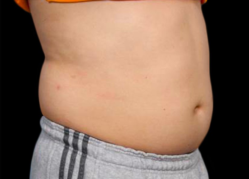 avant apres abdomen emsculpt