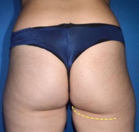 avant apres fesses femme emsculpt