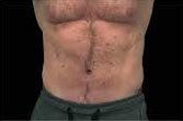 EMSCULPT VENTRE apres