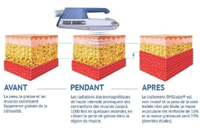 shéma emsculpt