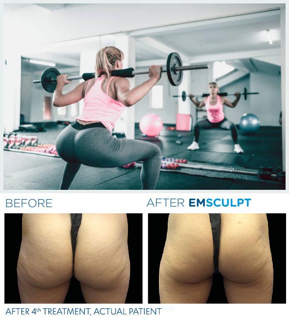 squat-emsculpt avant apres